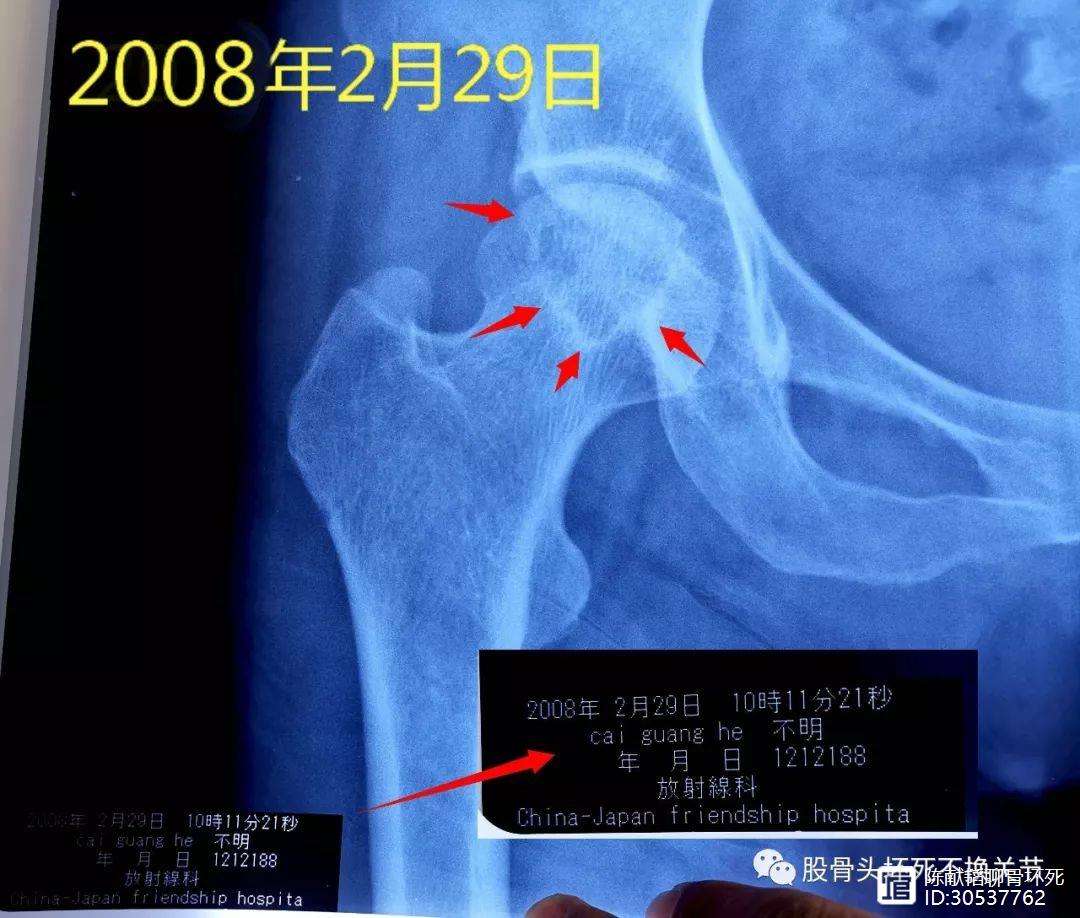 新余人工骨头医保报销多少(人工骨头医保报销多少比例)
